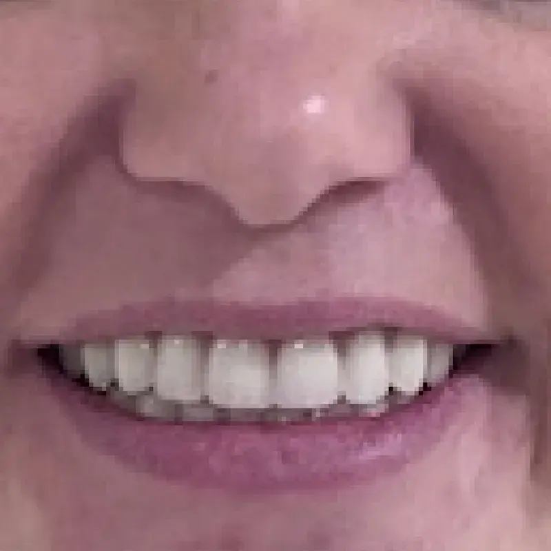 After: Restored Front Tooth & Refreshed Smile — patient of Dr. Matthew Phillips