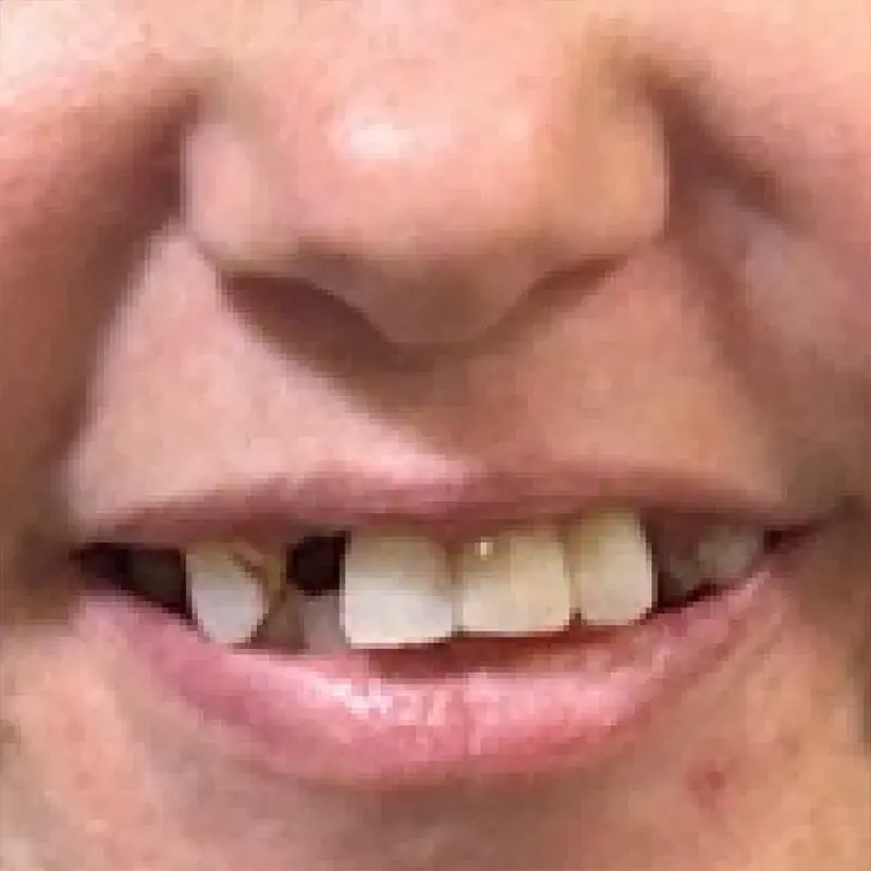 Before: Restored Front Tooth & Refreshed Smile — patient of Dr. Matthew Phillips