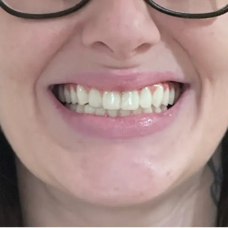 After: Cosmetic Smile Makeover — patient of Dr. Matthew Phillips