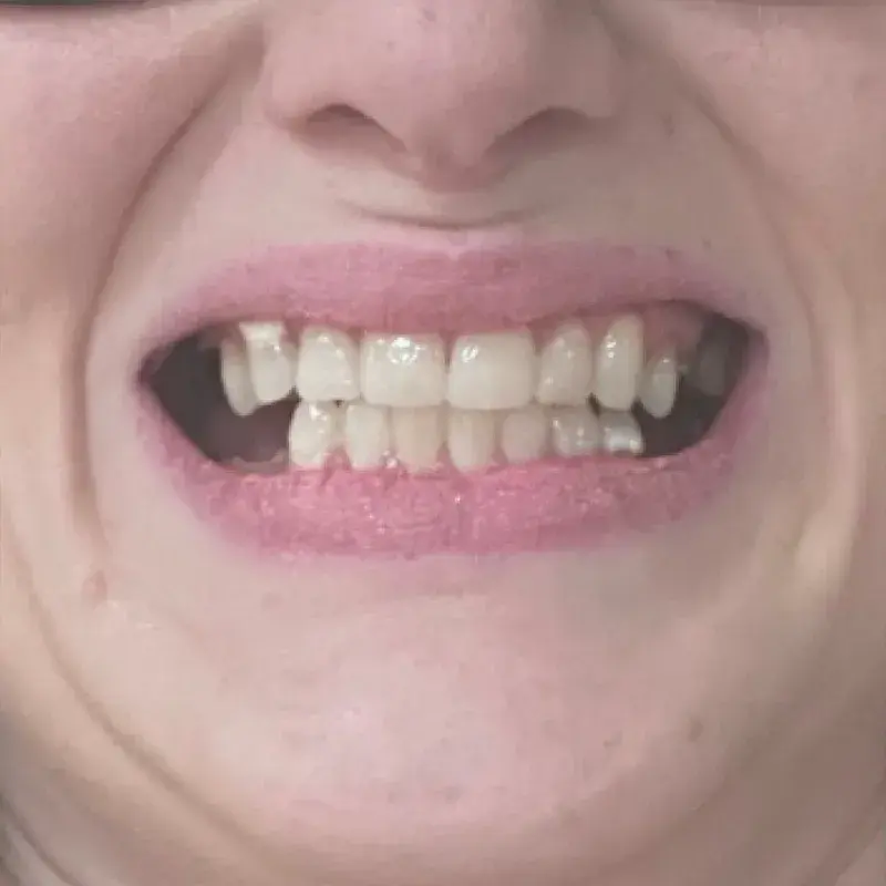 Before: Cosmetic Smile Makeover — patient of Dr. Matthew Phillips
