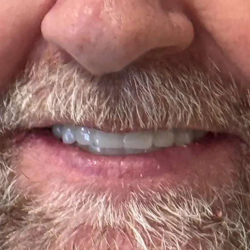 After: Rebuilt a Worn, Damaged Smile — patient of Dr. Matthew Phillips