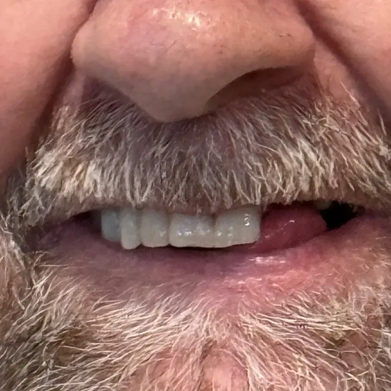 Before: Rebuilt a Worn, Damaged Smile — patient of Dr. Matthew Phillips