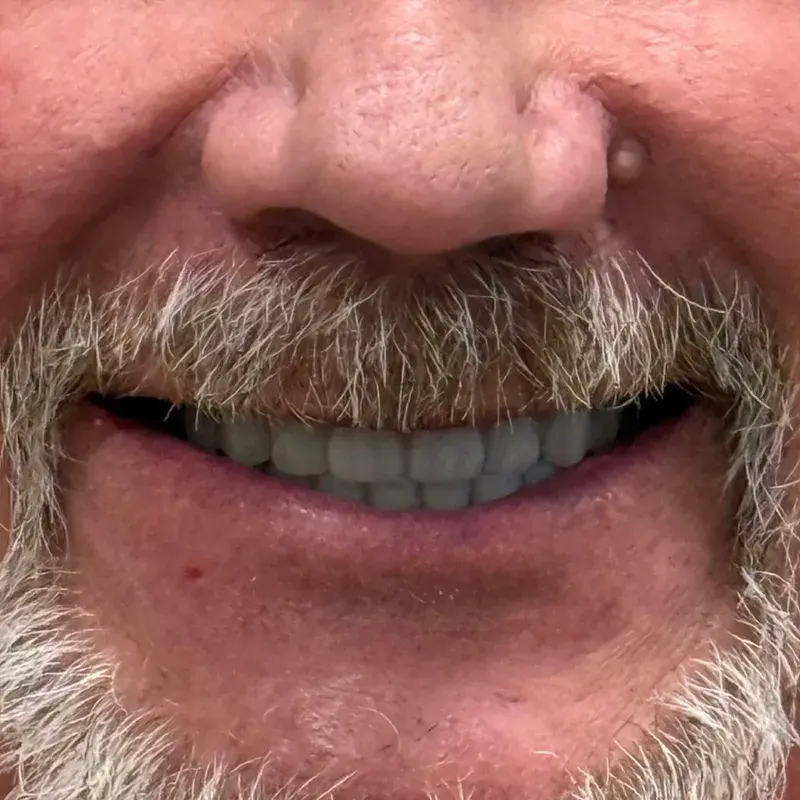 After: Full-Arch Implant Restoration — patient of Dr. Matthew Phillips