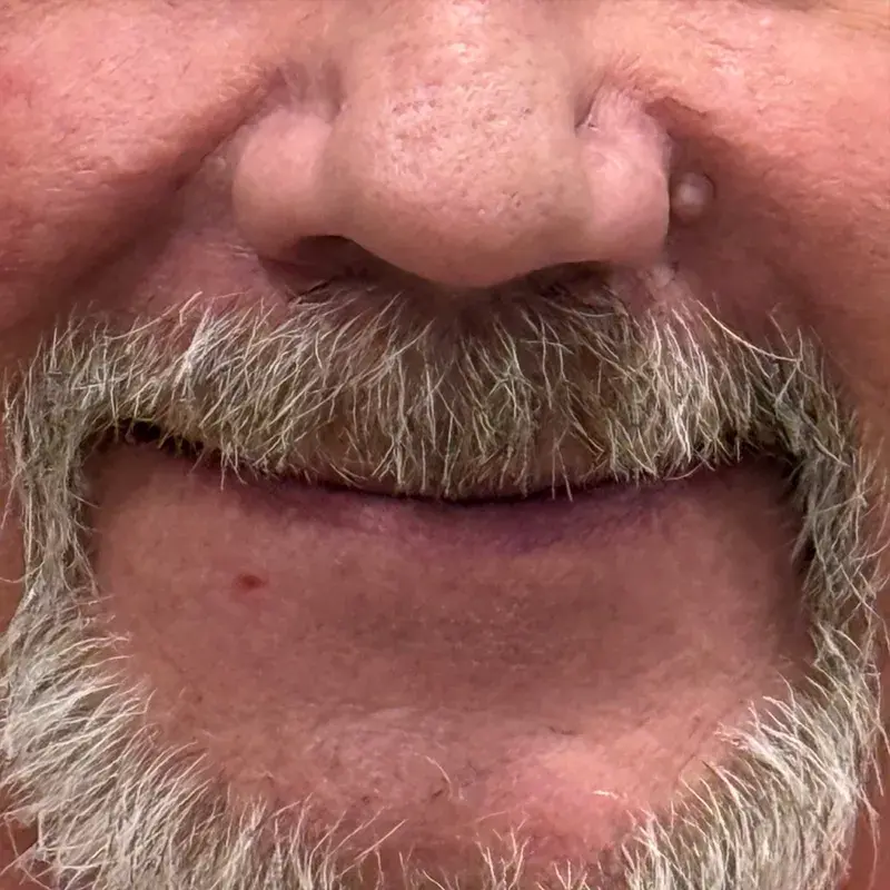 Before: Full-Arch Implant Restoration — patient of Dr. Matthew Phillips